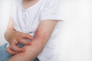Nový EUNI kurz: Kvalita života dětí s atopickou dermatitidou