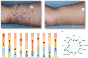 Účinnost dupilumabu u dětí s atopickou dermatitidou s různými fenotypy a endotypy: příklady z praxe