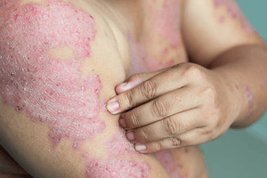 Dvojkombinace cyklosporinu A a acitretinu: rychlejší kontrola těžké psoriázy u pacientů mimo biologickou léčbu